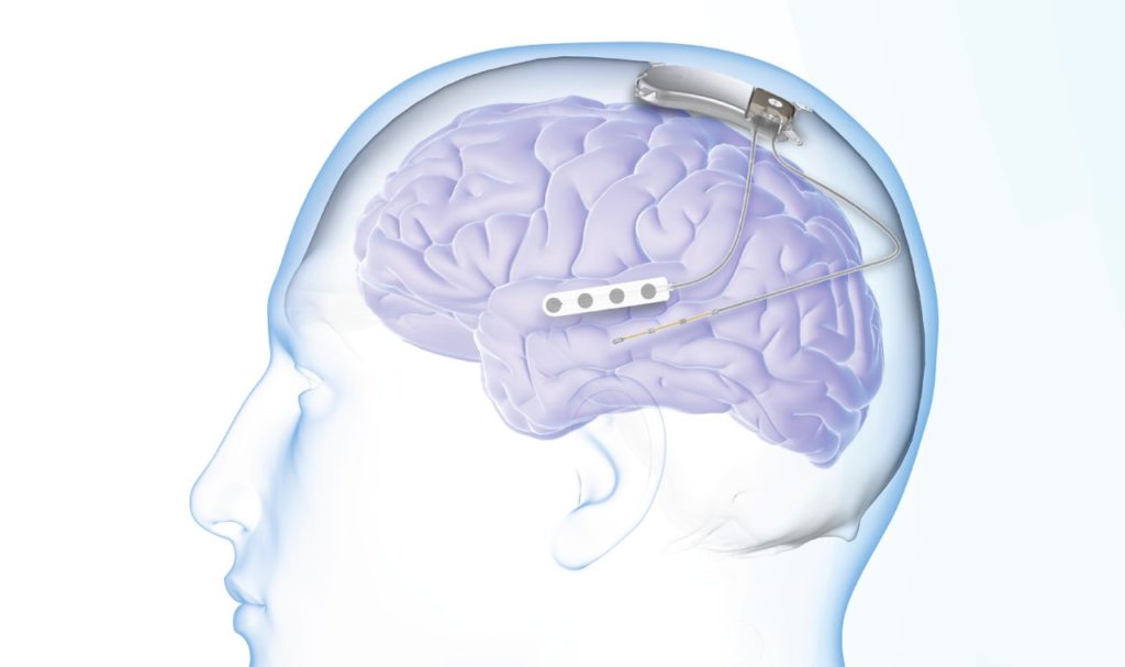 Image by NeuroPace